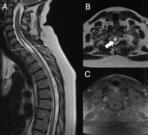 Sagittal T2 MRI showing syringomyelia extending from mid-cervical to lower lumbar cord