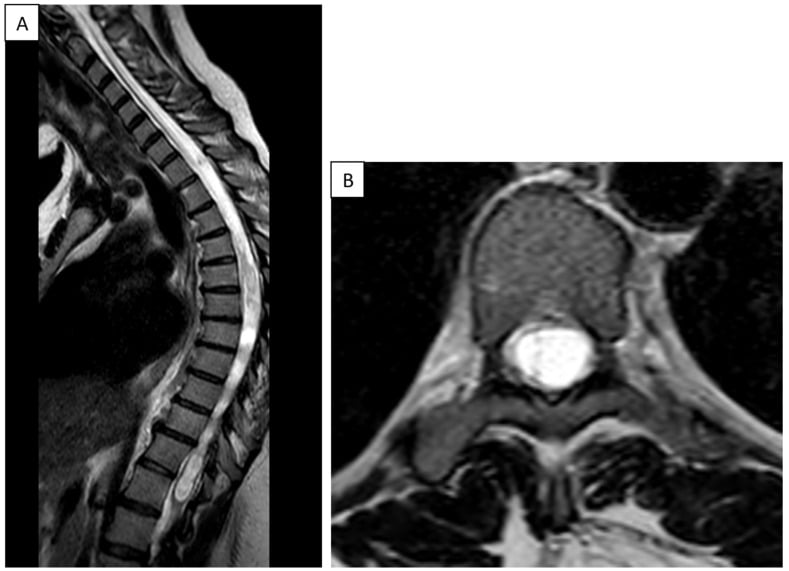 Sagittal and axial T2 MRI of the thoracic spine showing an intramedullary syrinx