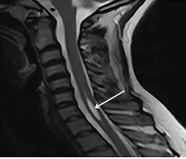 Sagittal T2 MRI showing a cervical syrinx without tonsillar descent in Chiari 0 malformation