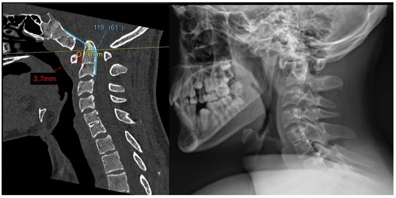 Mid-sagittal cervical CT and radiograph showing basilar invagination with superior and posterior dens translation