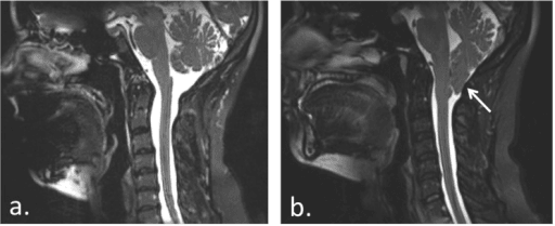 Side-by-side sagittal T2 MRI comparing a normal craniocervical junction with a Chiari I malformation