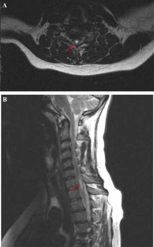 Axial and sagittal T2 cervical MRI showing a hyperintense syrinx cavity within the spinal cord