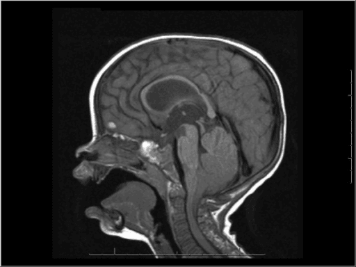 Mid-sagittal T1-weighted brain MRI showing cerebellar tonsils descending below the foramen magnum