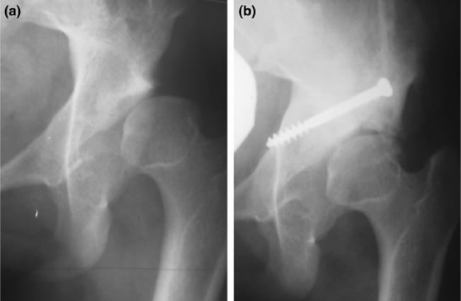 AP hip radiographs before and after Chiari osteotomy in a case with prior open reduction and Dega osteotomy for developmental dysplasia of the hip