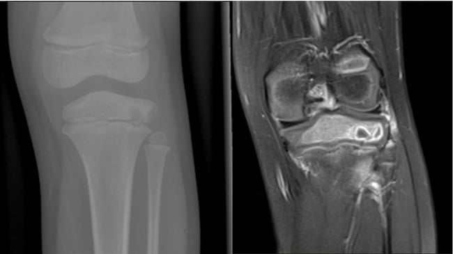 Radiograph and MRI of epiphyseal osteomyelitis mimicking chondroblastoma