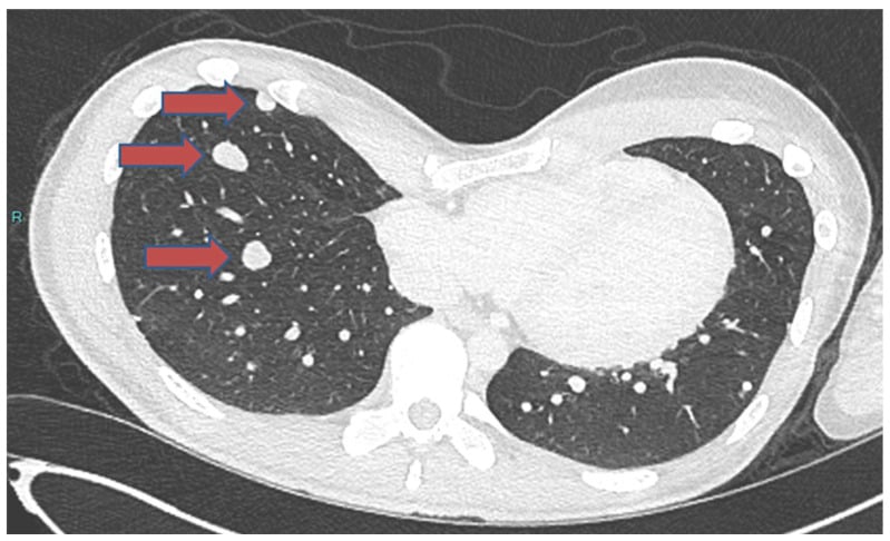 Chest CT showing pulmonary metastatic nodules from chondroblastoma