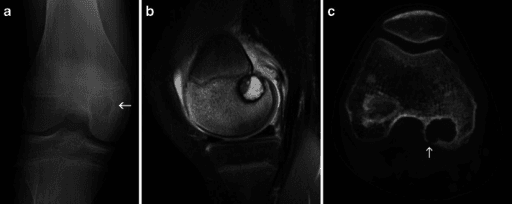 Frontal knee radiograph, MRI and CT of a chondroblastoma of the distal femoral epiphysis