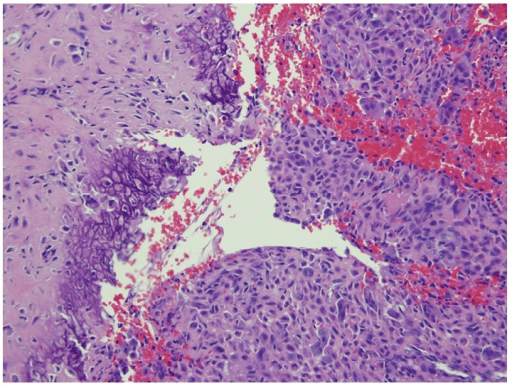 Histology showing chondroblasts, giant cells and chicken-wire calcification