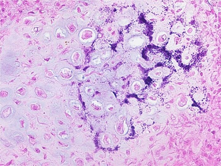 Histology of curetted chondroblastoma with chondroblast-type cells and giant cells