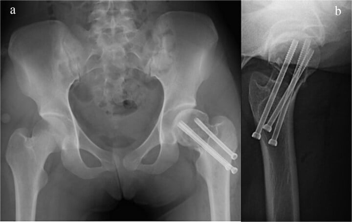 Radiograph after curettage, grafting and canulated screw fixation of a chondroblastoma