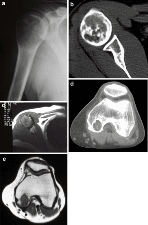 Radiograph and CT of a lytic humeral lesion with cortical thinning and calcification