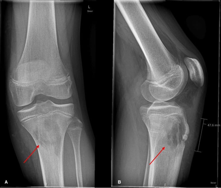 Knee radiograph showing a lytic proximal tibial metaphyseal lesion
