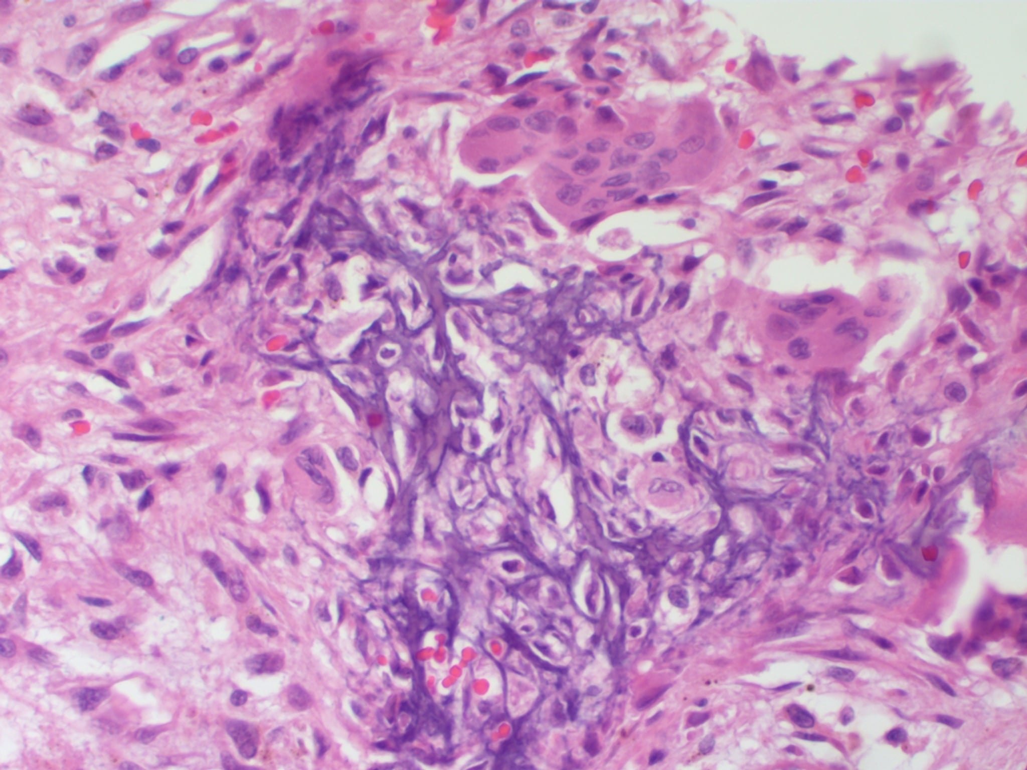 H&E histology of chondroblastoma showing chicken-wire calcification around chondroblasts.