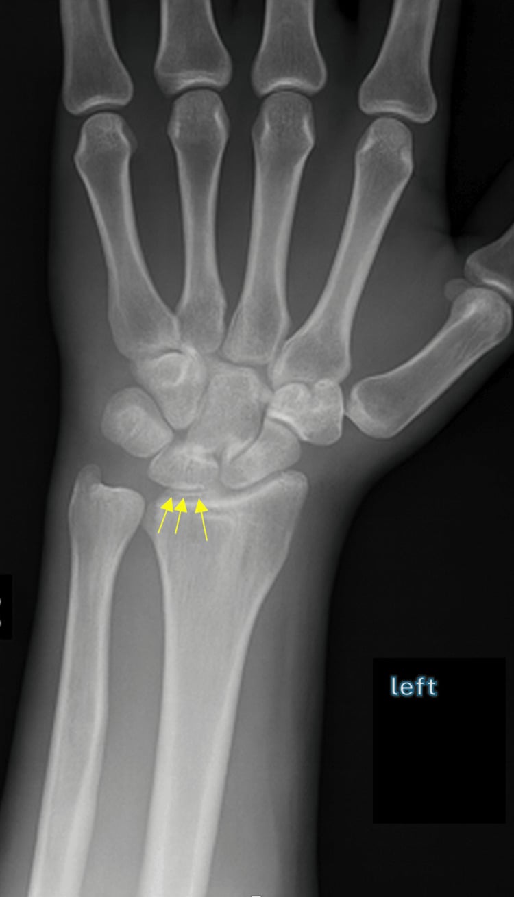 PA wrist radiograph demonstrating TFCC chondrocalcinosis
