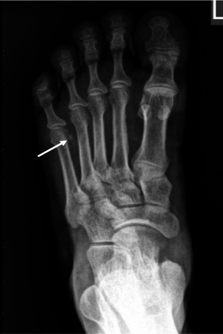 Plain radiograph demonstrating articular hyaline chondrocalcinosis