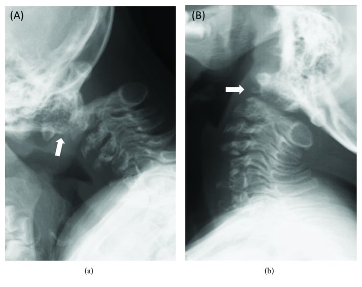 Flexion and extension cervical radiographs showing atlantoaxial instability and os odontoideum in brachytelephalangic chondrodysplasia punctata