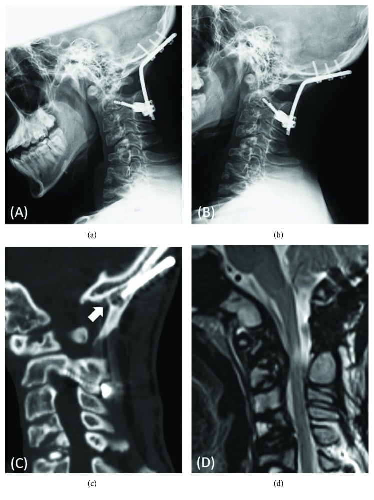 Postoperative radiographs, CT and MRI after occipitocervical fusion for atlantoaxial instability