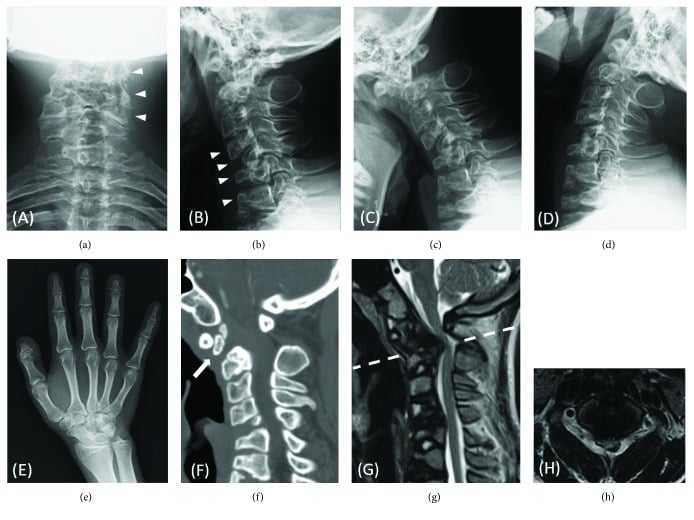 Preoperative radiographs, CT and MRI defining cervical deformity and cord compression in brachytelephalangic chondrodysplasia punctata
