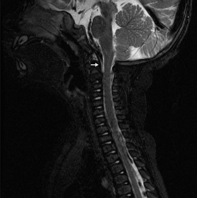 Sagittal cervical MRI showing reduced foramen magnum calibre in Conradi-Hünermann-Happle syndrome