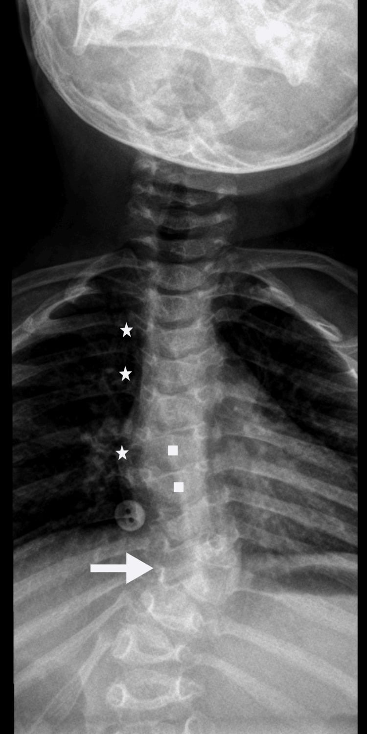 Spine radiograph showing costal and vertebral stippling, scoliosis and vertebral dysmorphism in CDPX2
