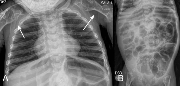 Chest and abdominal radiographs of a neonate with rhizomelic chondrodysplasia punctata showing punctate epiphyseal calcifications and rhizomelic humeral/femoral shortening