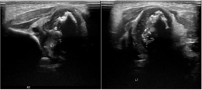 Bilateral hip ultrasound showing punctate calcification within both femoral head epiphyses