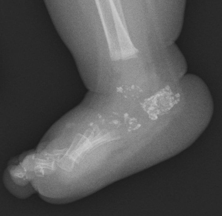 Infant foot radiograph showing numerous punctate calcifications in the tarsal bones and phalanges