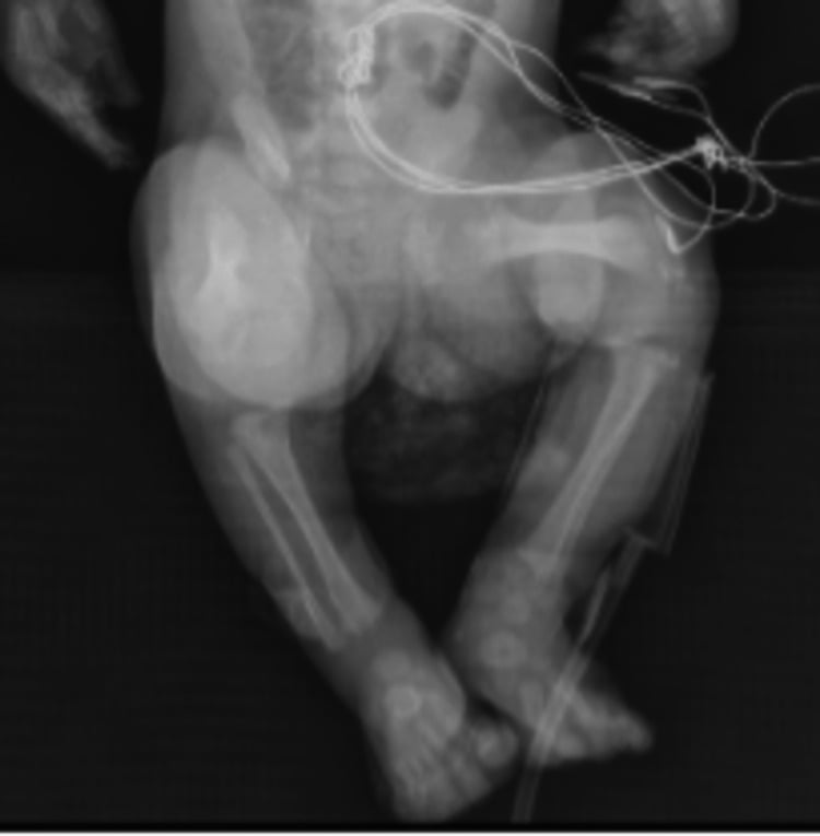Lower-limb skeletal survey showing short femora, metaphyseal flaring and proximal and distal stippling