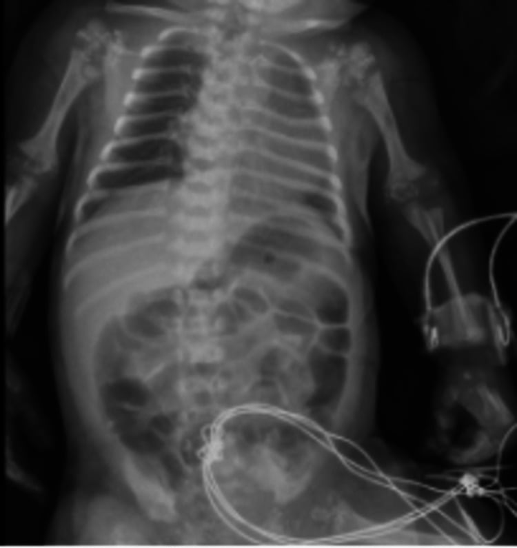 Upper-limb skeletal survey showing short humeri, metaphyseal flaring and periarticular stippling