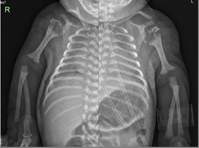 Upper-limb radiographs showing short humeri, metaphyseal flaring and epiphyseal stippling in RCDP2