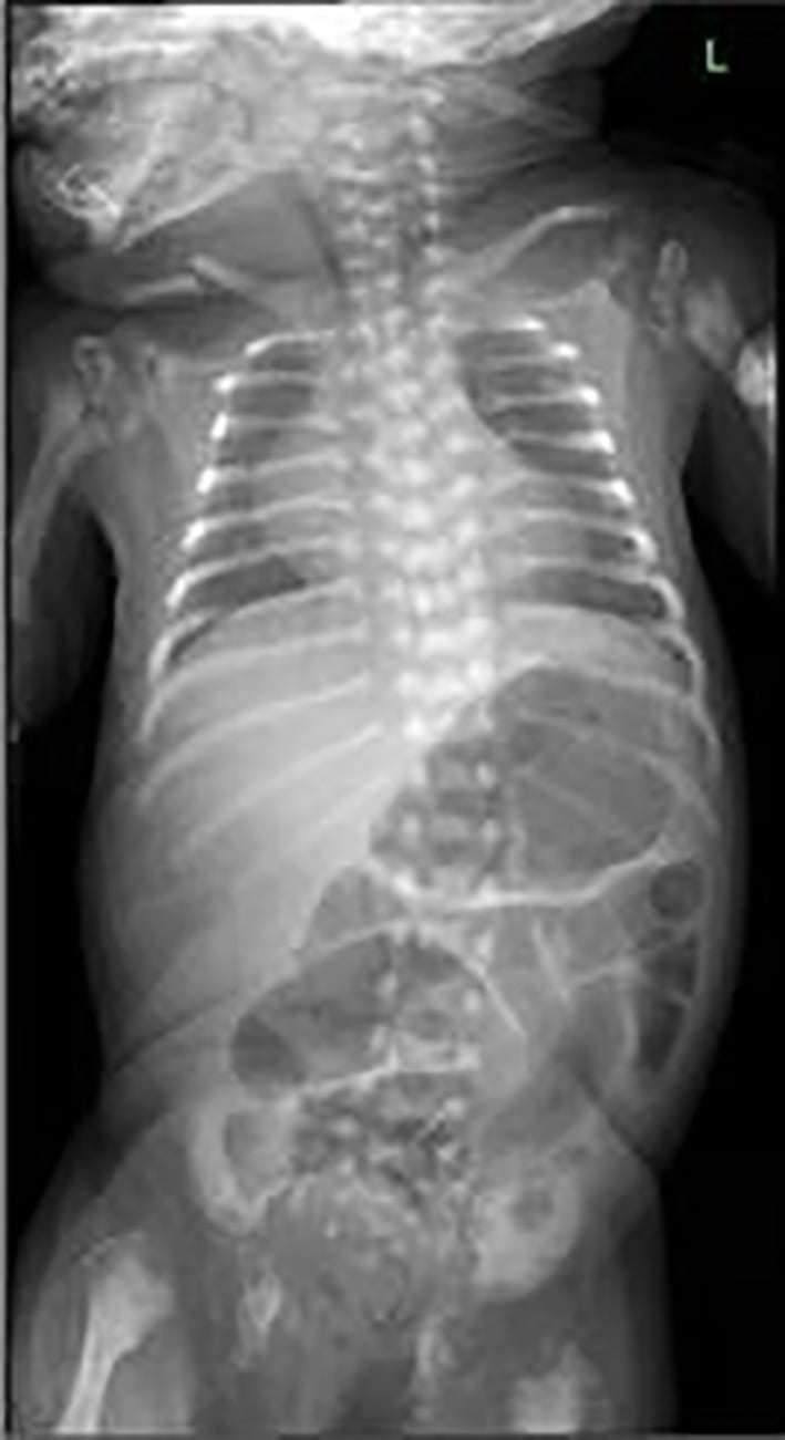 Neonatal chest and abdominal radiographs showing extensive vertebral punctate calcification in RCDP2