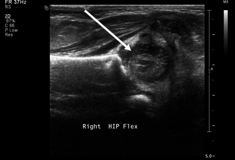 Hip ultrasound showing bilateral dislocation of the femoral heads in RCDP3