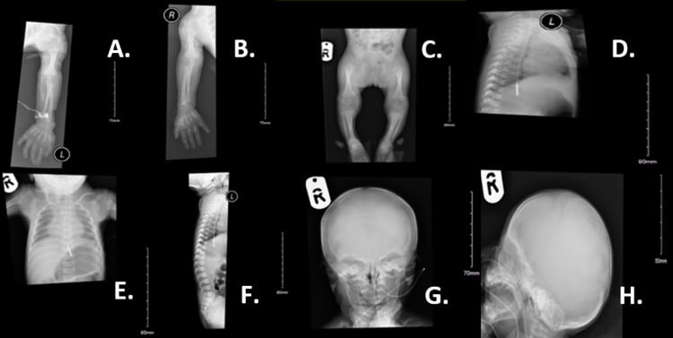 Rhizomelic chondrodysplasia punctata skeletal survey showing short humeri and femora with periarticular stippling