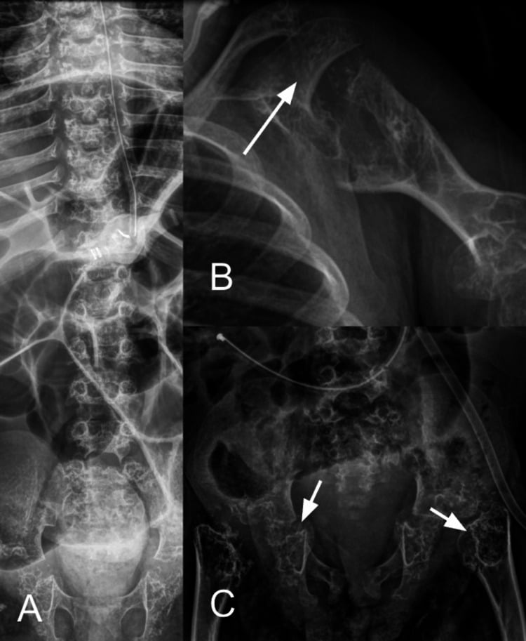 Magnified radiographs of the spine, humerus, and pelvis showing punctate cartilaginous calcifications and abnormal acetabular development in chondrodysplasia punctata