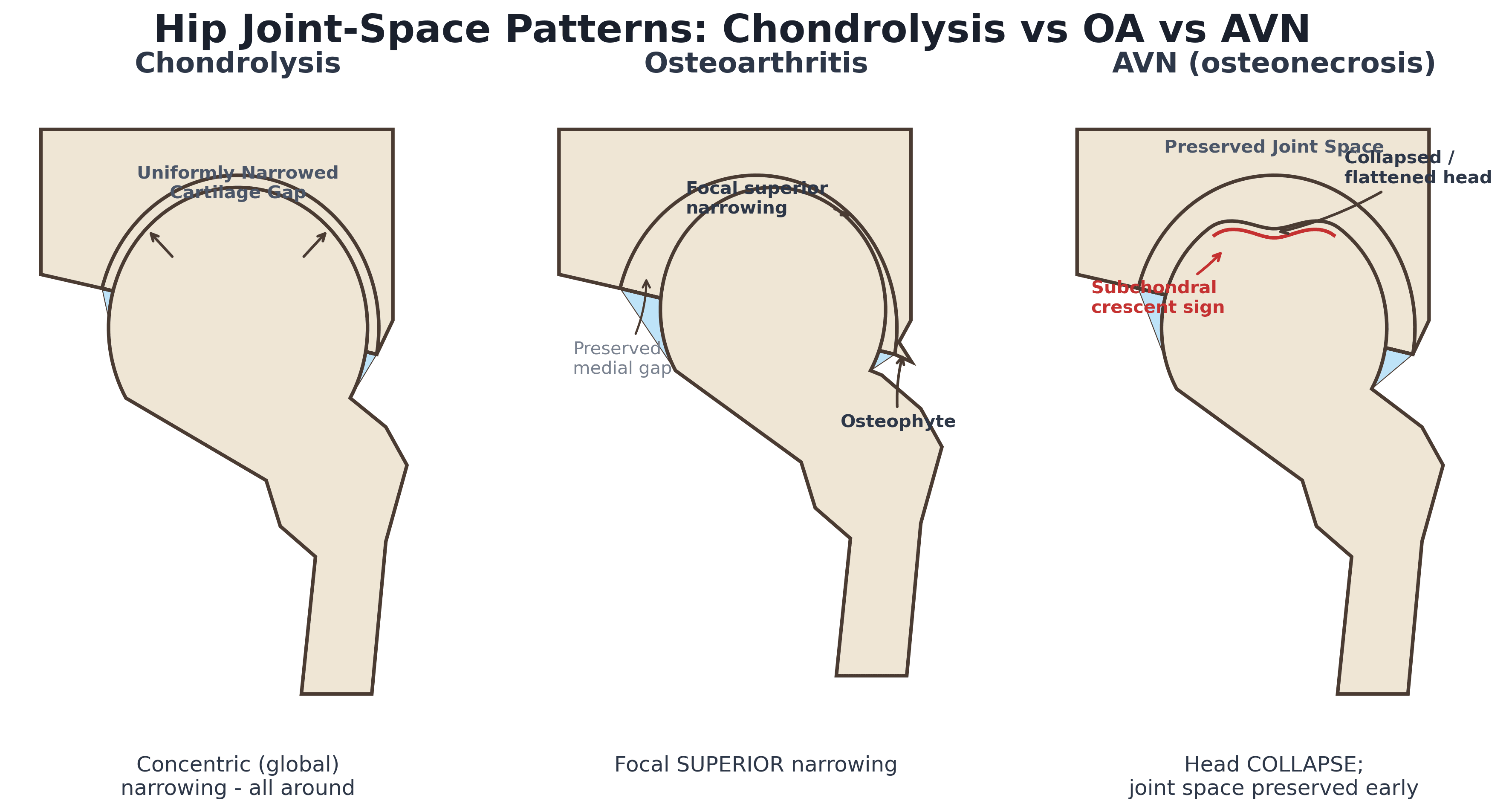 Three-panel hip diagram contrasting concentric joint-space narrowing in chondrolysis, focal superior narrowing in osteoarthritis, and femoral head collapse in avascular necrosis