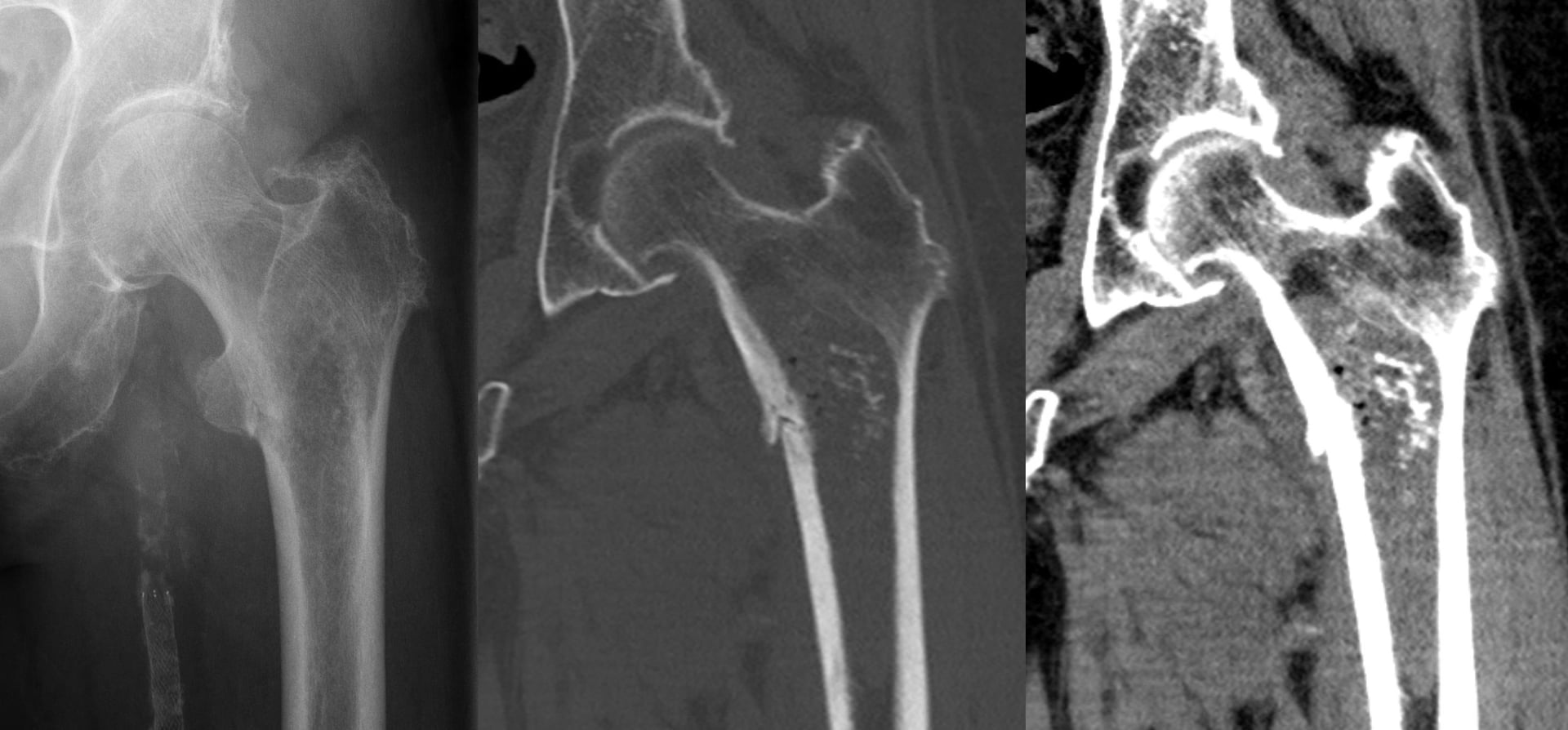 Radiograph and CT of a high-grade chondrosarcoma of the proximal femur.