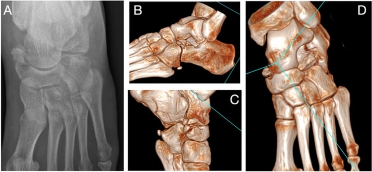 4-panel Chopart injury imaging with AP X-ray and 3D CT reconstructions