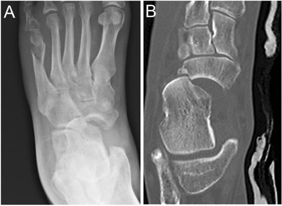 TNJ fracture-dislocation on AP X-ray and axial CT showing talar head dislocation