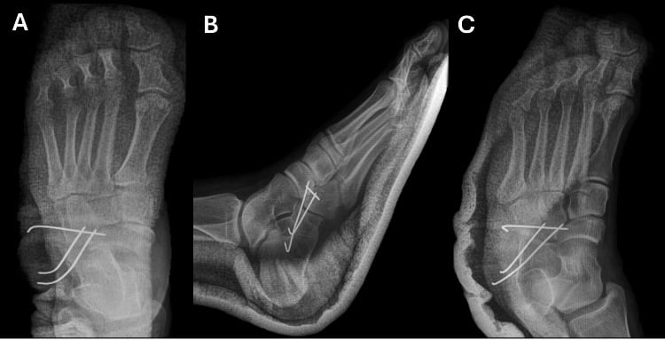Postoperative dorsoplantar, lateral and oblique radiographs showing crossed K-wire fixation of the calcaneocuboid joint