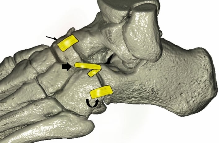 Volume-rendered dorsal Chopart anatomy with the dorsal talonavicular, bifurcate and dorsal calcaneocuboid ligaments highlighted