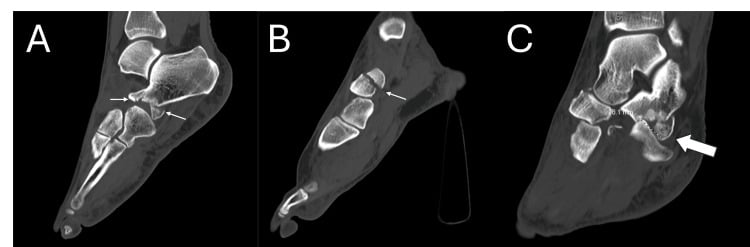 Sagittal and coronal CT showing navicular fracture, naviculocuneiform dislocation and calcaneocuboid fracture-dislocation