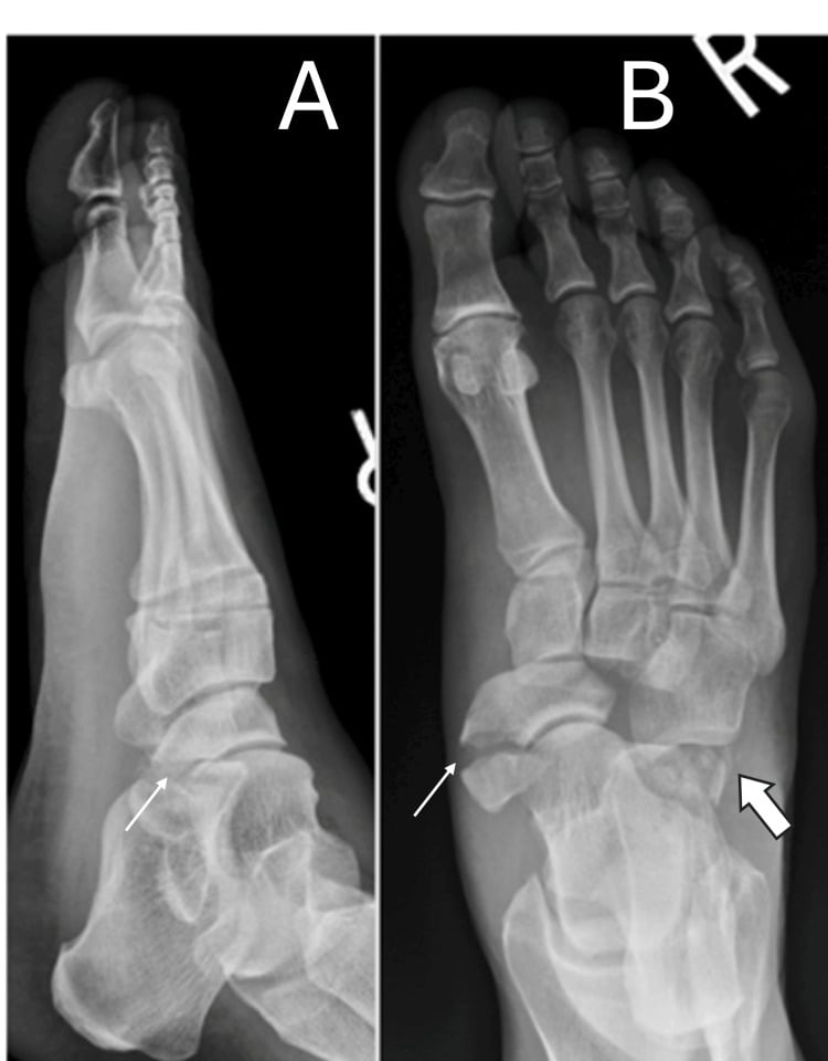 Lateral (A) and dorsoplantar (B) radiographs showing calcaneocuboid dislocation with an anterior-process calcaneal fracture, and a navicular fracture with naviculocuneiform disruption