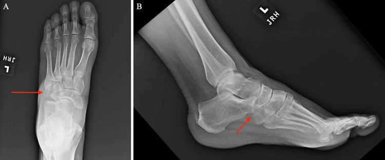 Dorsoplantar and lateral radiographs of the left foot with red arrows marking a comminuted cuboid fracture