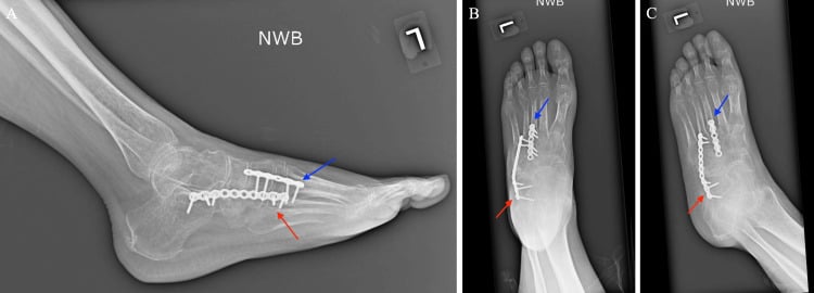Postoperative non-weight-bearing radiographs showing a cuboid bridge plate (red arrows) maintaining lateral-column length and a second plate (blue arrows)