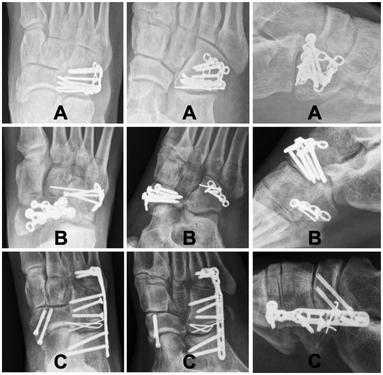 Radiographic comparison of three operative fixation constructs for cuboid fractures