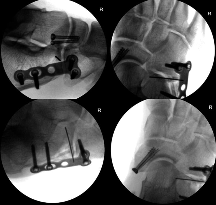 Intraoperative fluoroscopy showing navicular screw fixation and a plate spanning the calcaneocuboid joint