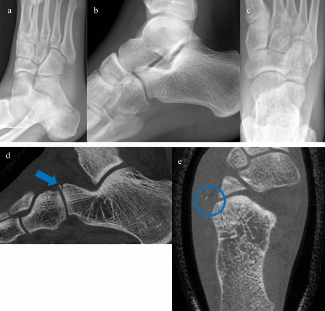 Oblique, lateral and dorsoplantar foot radiographs without a visible fracture, and cone-beam CT revealing an anterior-process calcaneal fracture