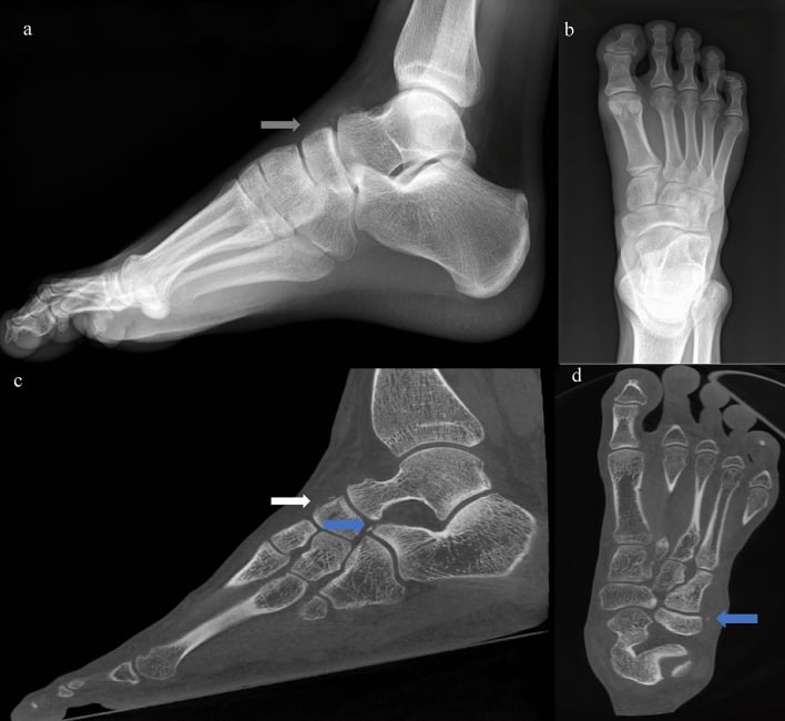 Lateral and dorsoplantar radiographs and cone-beam CT showing a dorsal talonavicular avulsion and radiographically occult lateral Chopart fragments