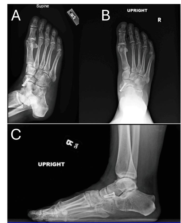 Follow-up foot radiographs, one labelled supine (A) and two labelled upright (B, C), after removal of temporary calcaneocuboid fixation