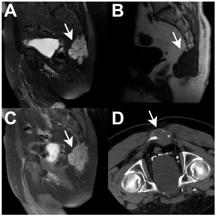 Multisequence MRI and CT appearance of a sacral chordoma